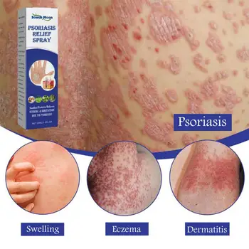 Cilt Sedef Sprey Bitki Özü Dermatit Eczematoid Egzama Merhem Tedavisi Sedef Anti Kaşıntı Antibakteriyel Sprey